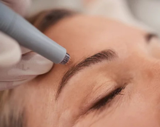 Microneedling