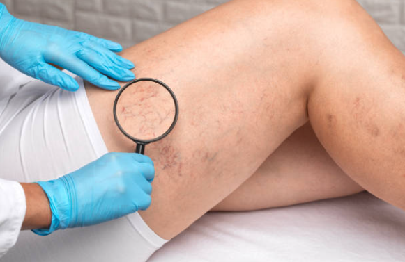 Spider Vein Removal